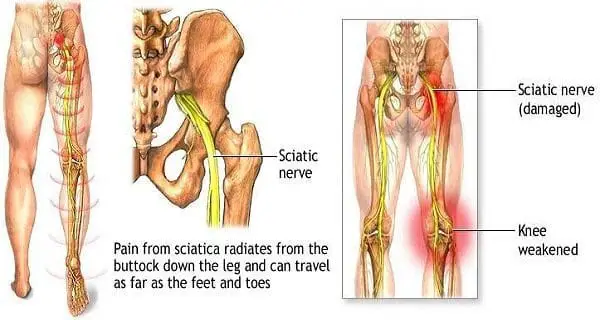 7 Yoga Poses to Ease Sciatica Pain
